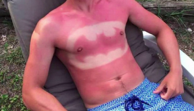 Sunburn-Art