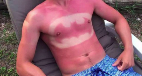 Sunburn-Art